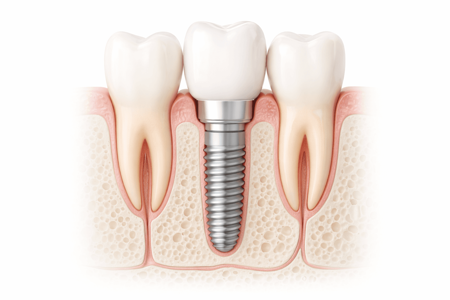 Dental Implants